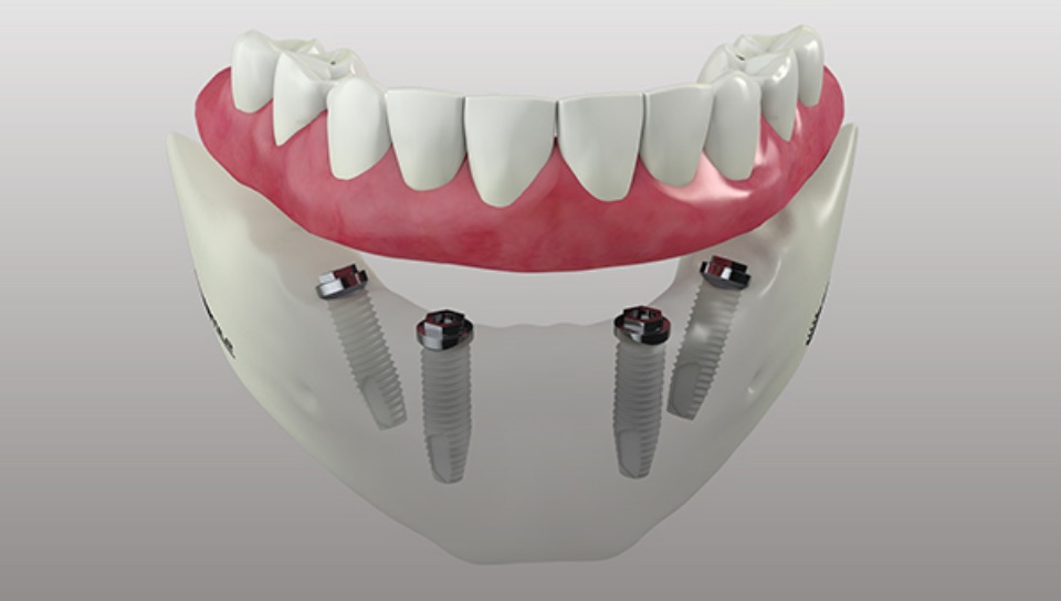 Dentista Anguillara Sabazia | Studio Dentistico Calderini